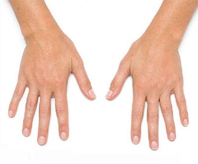 Radiesse for Hand Rejuvenation Before & After Gallery - Patient 294191 - Image 2