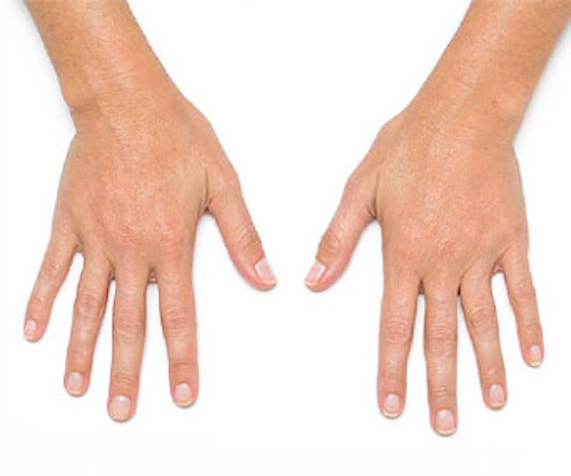 Radiesse for Hand Rejuvenation Before & After Gallery - Patient 294191 - Image 2