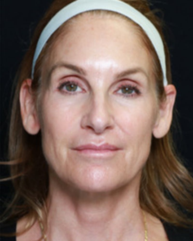 Renuva Biostimulator Before & After Gallery - Patient 261237 - Image 1