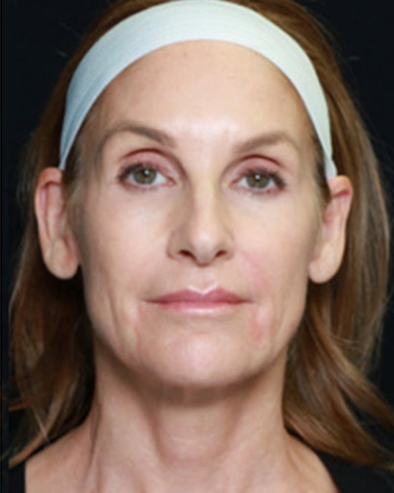 Renuva Biostimulator Before & After Gallery - Patient 261237 - Image 2