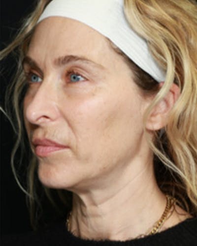 Renuva Biostimulator Before & After Gallery - Patient 209118 - Image 1