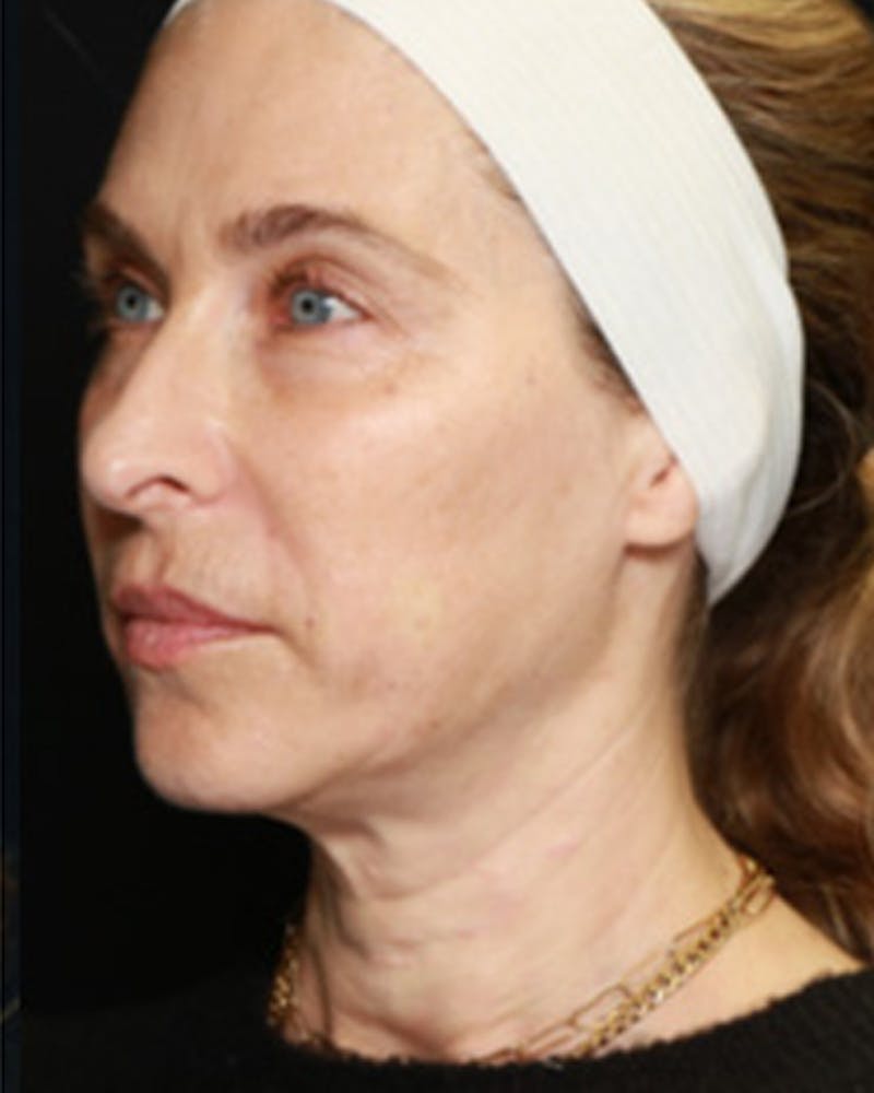 Renuva Biostimulator Before & After Gallery - Patient 209118 - Image 2