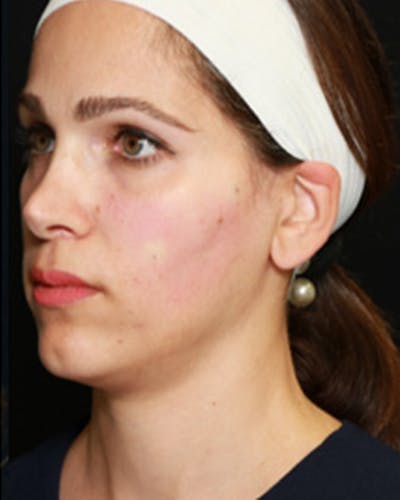 Renuva Biostimulator Before & After Gallery - Patient 198737 - Image 2