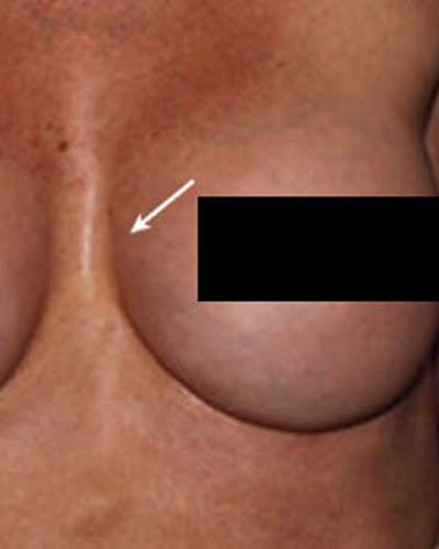 Renuva Body Contouring Before & After Gallery - Patient 177271 - Image 1