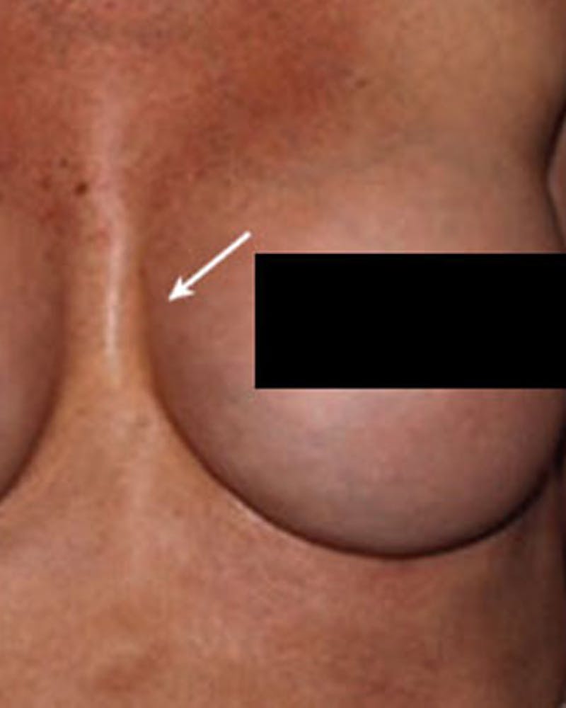Renuva Body Contouring Before & After Gallery - Patient 177271 - Image 1