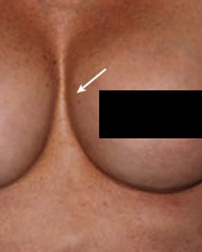 Renuva Body Contouring Before & After Gallery - Patient 177271 - Image 2