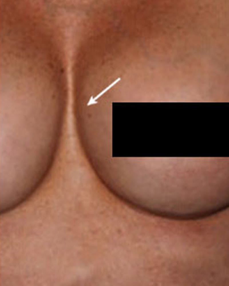Renuva Body Contouring Before & After Gallery - Patient 177271 - Image 2