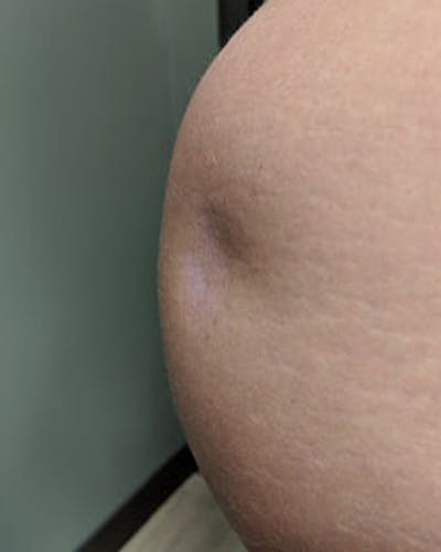 Renuva Body Contouring Before & After Gallery - Patient 153119 - Image 1