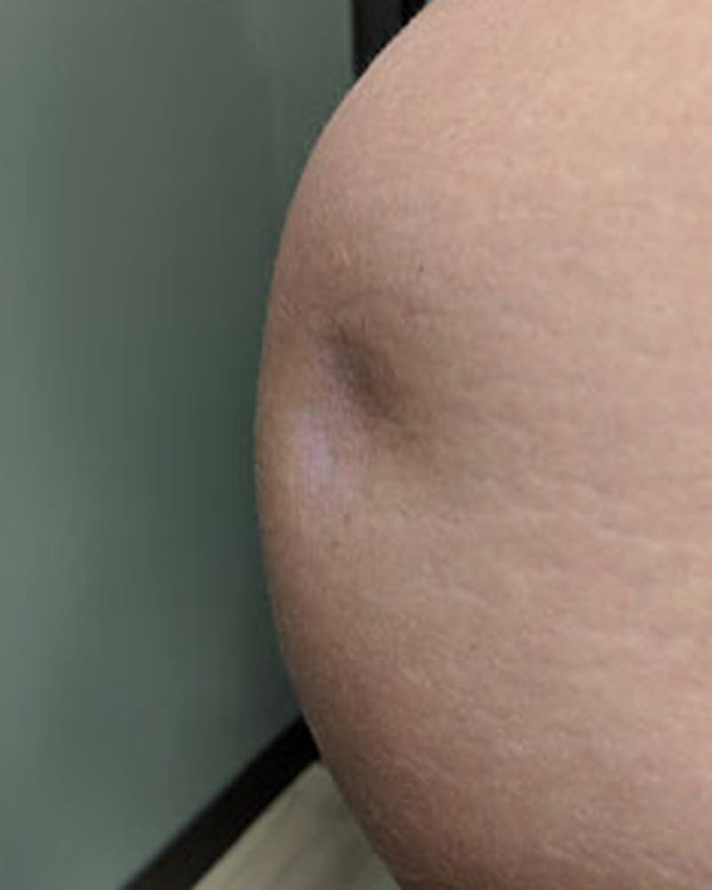 Renuva Body Contouring Before & After Gallery - Patient 153119 - Image 1