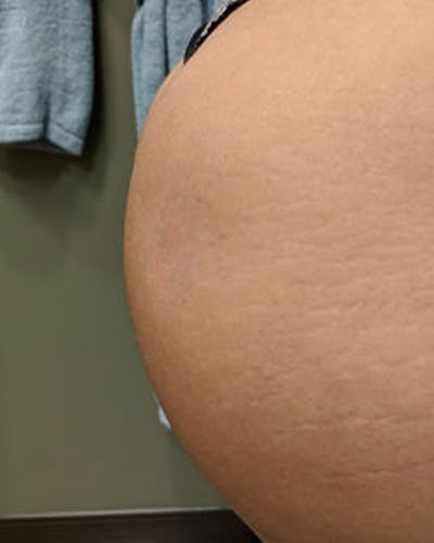 Renuva Body Contouring Before & After Gallery - Patient 153119 - Image 2