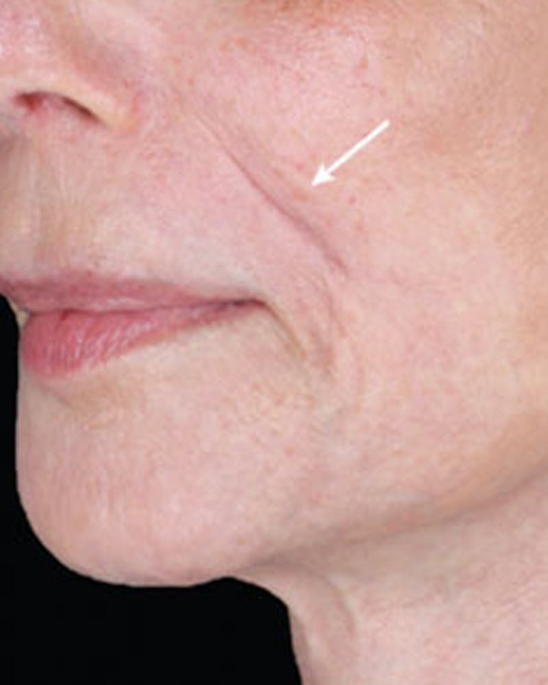 Renuva Biostimulator Before & After Gallery - Patient 354093 - Image 1