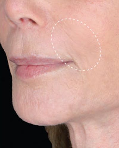 Renuva Biostimulator Before & After Gallery - Patient 354093 - Image 2