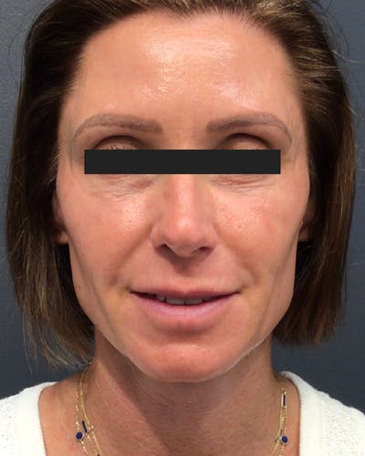 Sculptra Facelift Before & After Gallery - Patient 154004 - Image 1