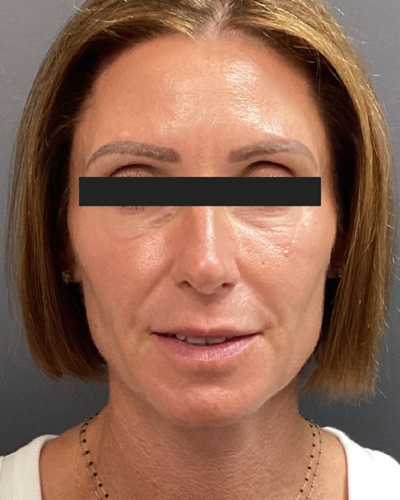 Sculptra Facelift Before & After Gallery - Patient 154004 - Image 2