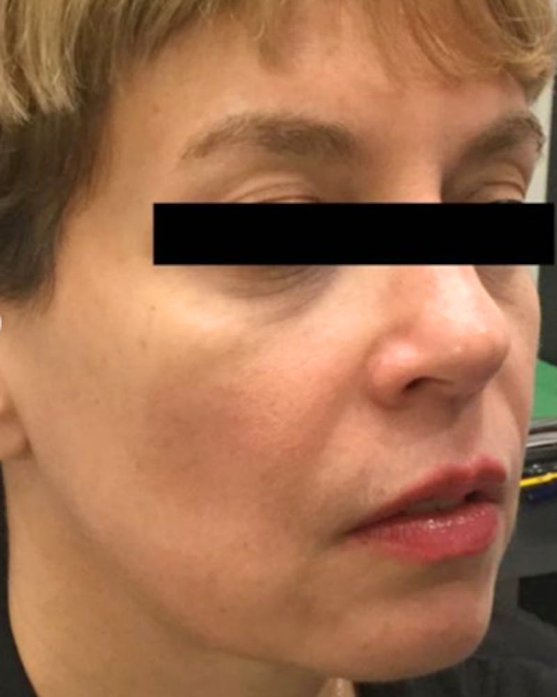 Sculptra Facelift Before & After Gallery - Patient 268896 - Image 1