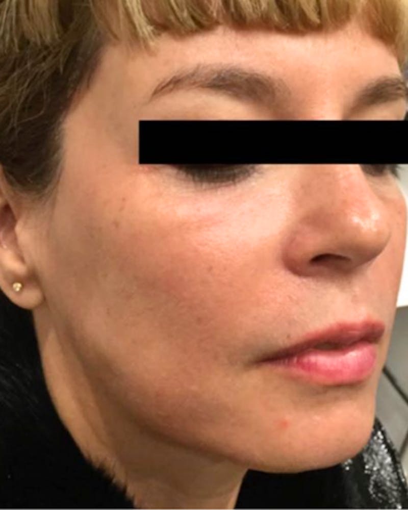 Sculptra Facelift Before & After Gallery - Patient 268896 - Image 2