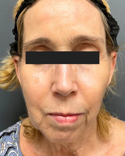 Sculptra Facelift Before & After Gallery - Patient 358590 - Image 1