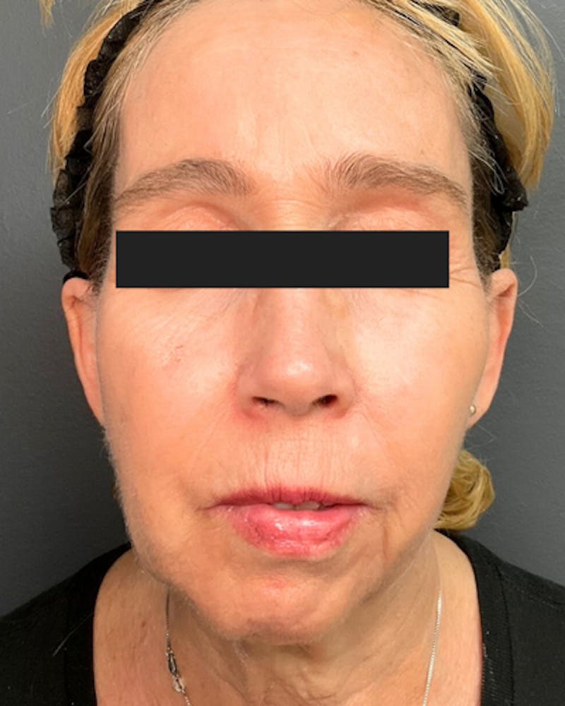Sculptra Facelift Before & After Gallery - Patient 358590 - Image 2