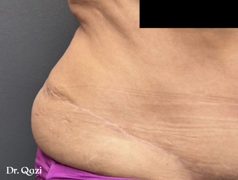 Smartlipo Before & After Gallery - Patient 235474 - Image 1