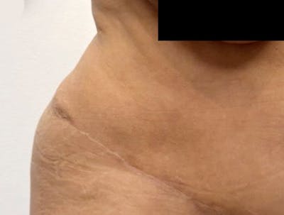 Smartlipo Before & After Gallery - Patient 235474 - Image 2