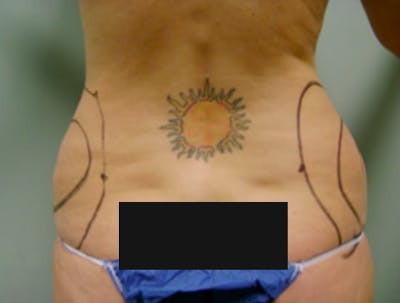 Smartlipo Before & After Gallery - Patient 131356 - Image 1