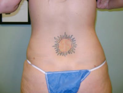 Smartlipo Before & After Gallery - Patient 131356 - Image 2