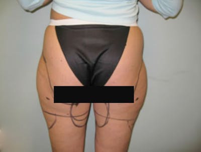 Smartlipo Before & After Gallery - Patient 341166 - Image 1