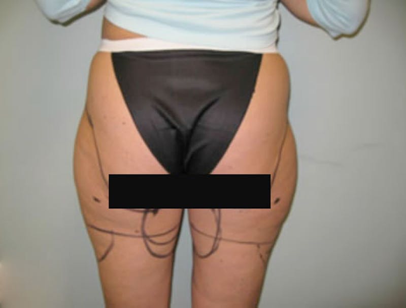 Smartlipo Before & After Gallery - Patient 341166 - Image 1