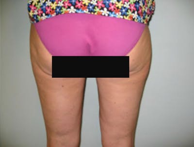 Smartlipo Before & After Gallery - Patient 341166 - Image 2