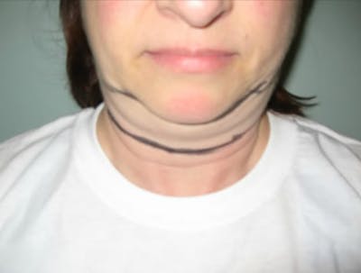 Smartlipo Before & After Gallery - Patient 441105 - Image 1