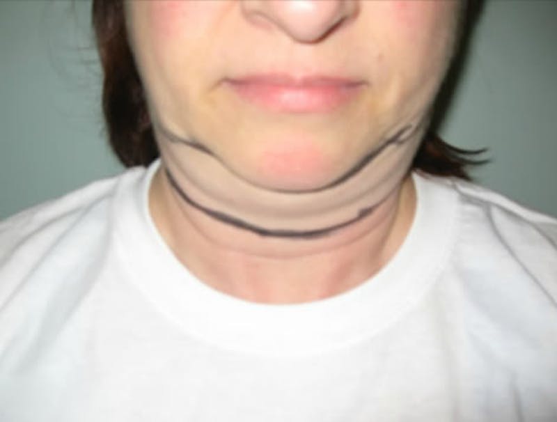 Smartlipo Before & After Gallery - Patient 441105 - Image 1