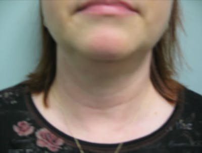 Smartlipo Before & After Gallery - Patient 441105 - Image 2