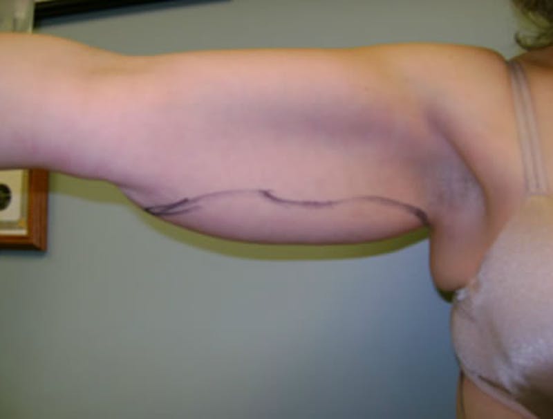 Smartlipo Before & After Gallery - Patient 529309 - Image 1