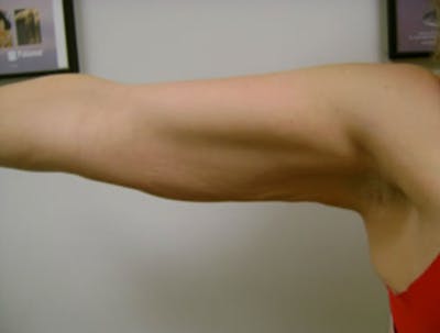Smartlipo Before & After Gallery - Patient 529309 - Image 2