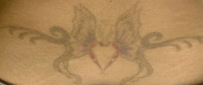 Tattoo Removal Before & After Gallery - Patient 987055 - Image 1