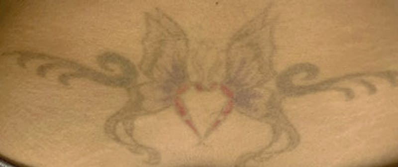 Tattoo Removal Before & After Gallery - Patient 987055 - Image 1