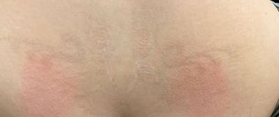 Tattoo Removal Before & After Gallery - Patient 987055 - Image 2