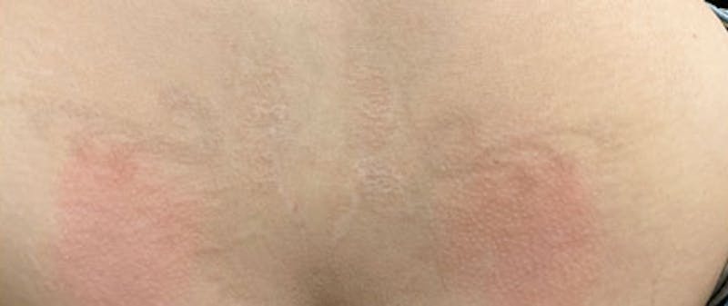 Tattoo Removal Before & After Gallery - Patient 987055 - Image 2