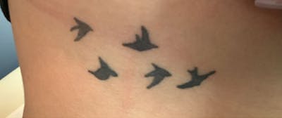 Tattoo Removal Before & After Gallery - Patient 167518 - Image 1