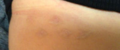 Tattoo Removal Before & After Gallery - Patient 167518 - Image 2