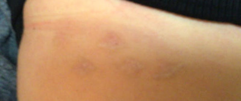 Tattoo Removal Before & After Gallery - Patient 167518 - Image 2