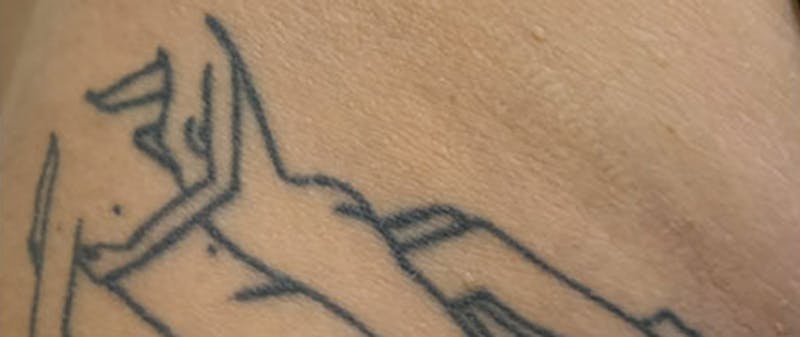 Tattoo Removal Before & After Gallery - Patient 397699 - Image 1