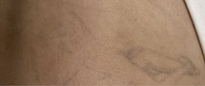 Tattoo Removal Before & After Gallery - Patient 397699 - Image 2