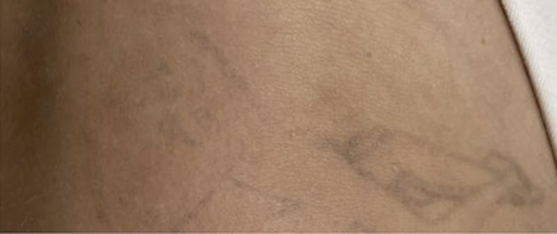 Tattoo Removal Before & After Gallery - Patient 397699 - Image 2