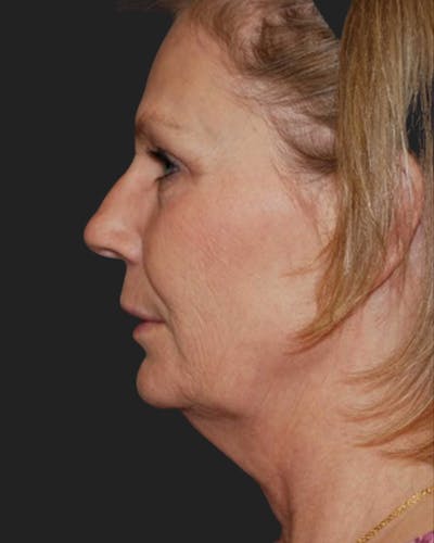 Thermage Before & After Gallery - Patient 384792 - Image 1