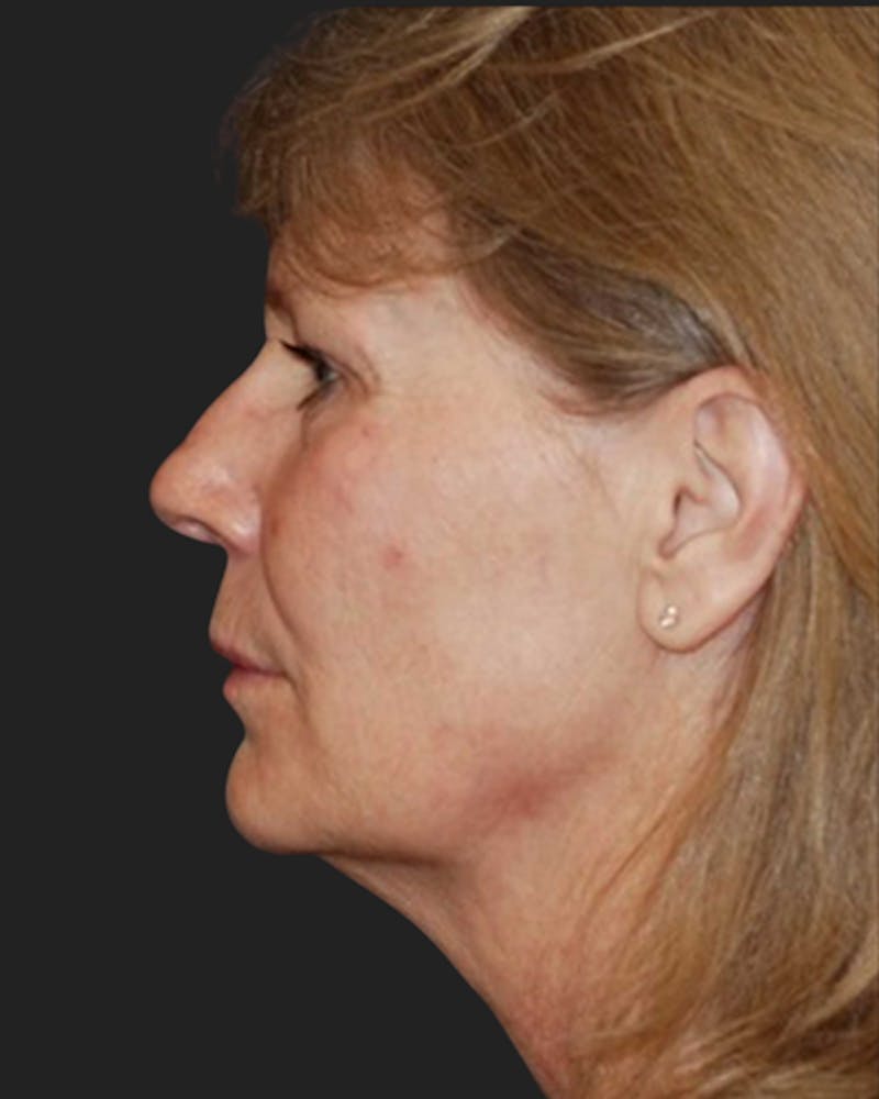 Thermage Before & After Gallery - Patient 384792 - Image 2