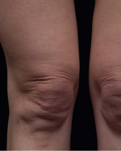 Thermage Before & After Gallery - Patient 363837 - Image 1