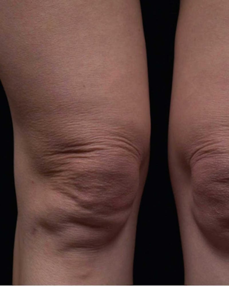 Thermage Before & After Gallery - Patient 363837 - Image 1