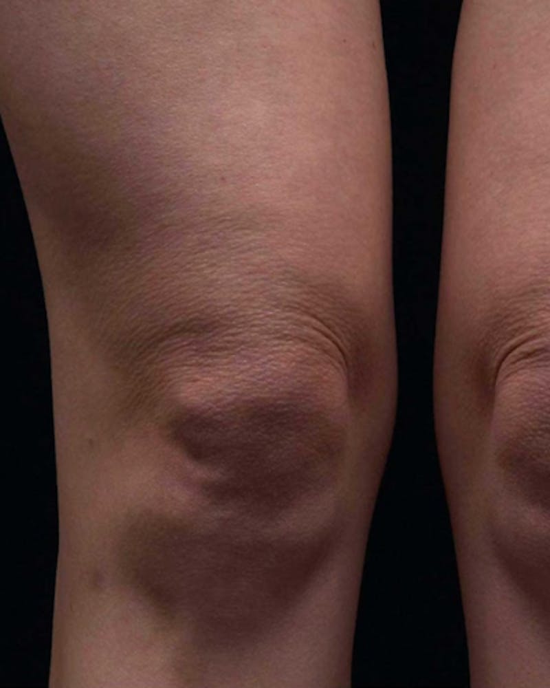 Thermage Before & After Gallery - Patient 363837 - Image 2