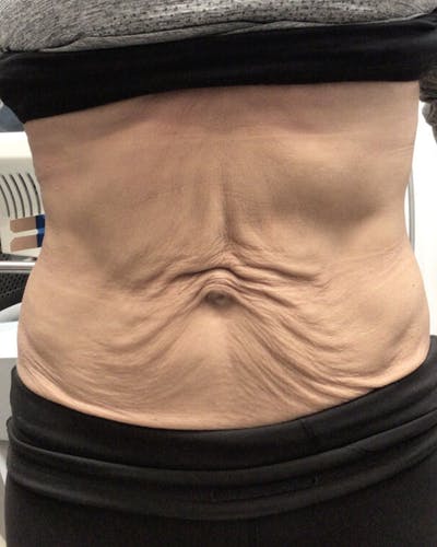 Thermage Before & After Gallery - Patient 343916 - Image 1